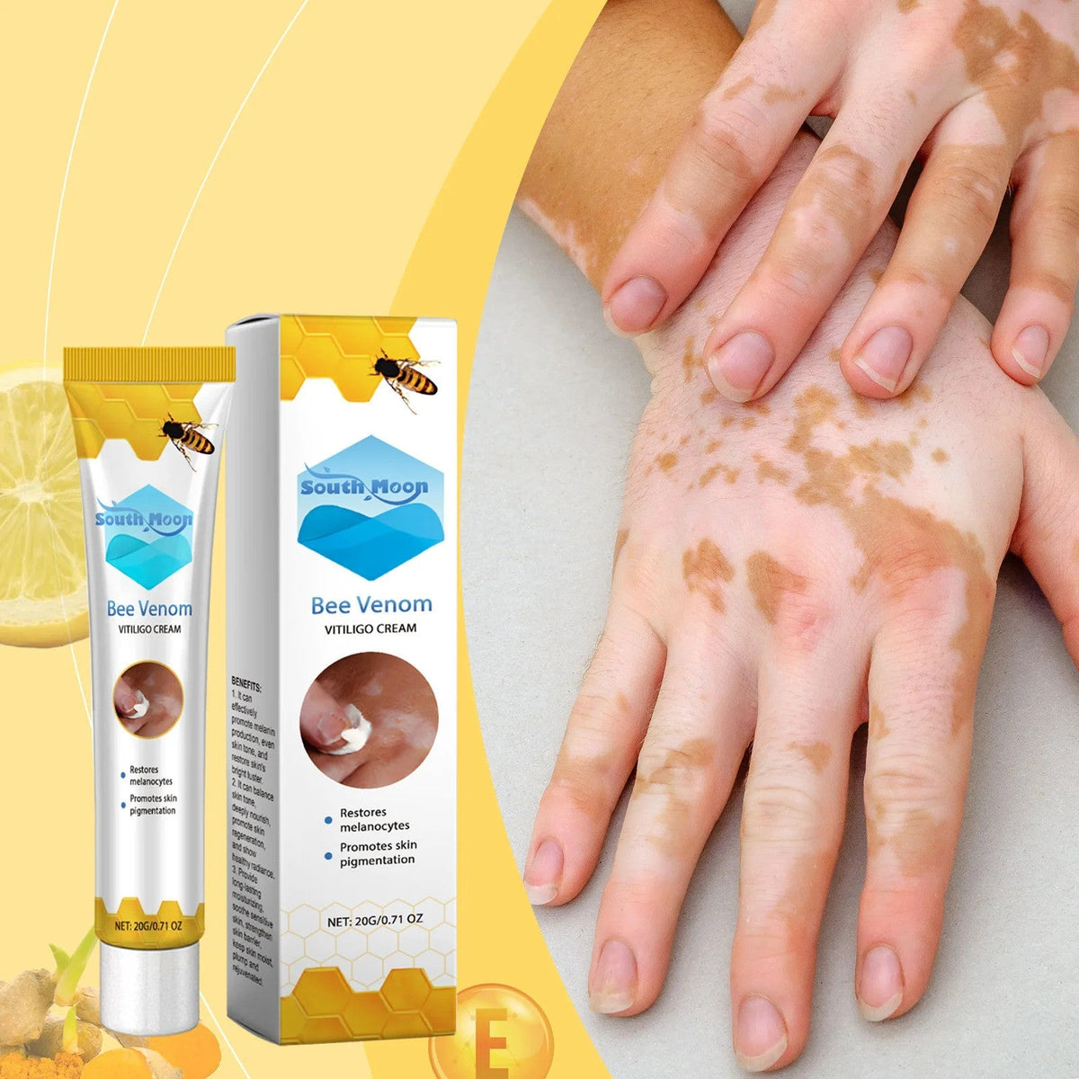 Vitiligo Bee Venom Treatment Cream