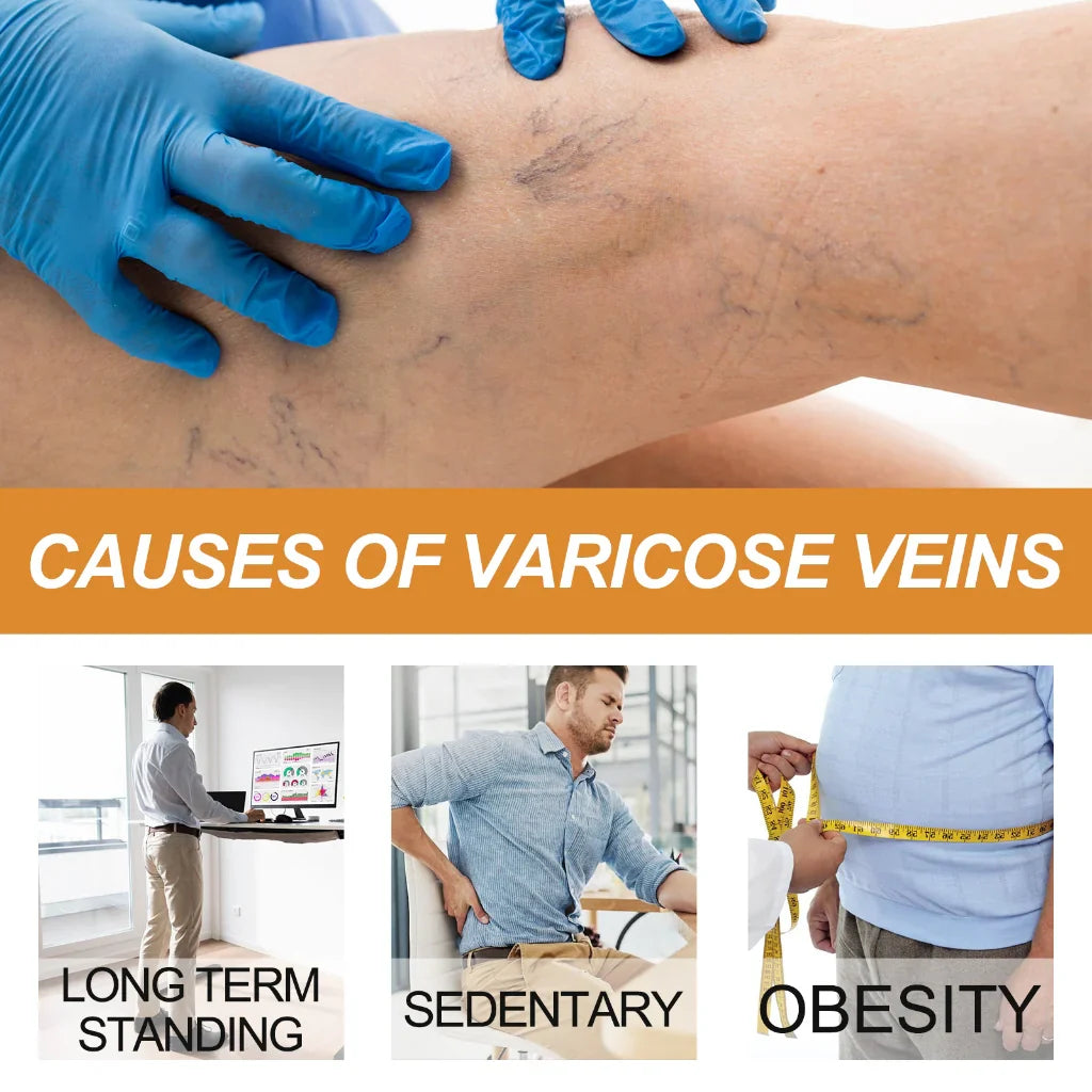 Varicose Vein Relief Spray